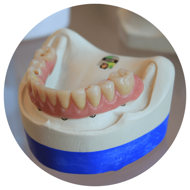 Realizzazione protesica rapida Studio Dentistico Del Ben - Trieste